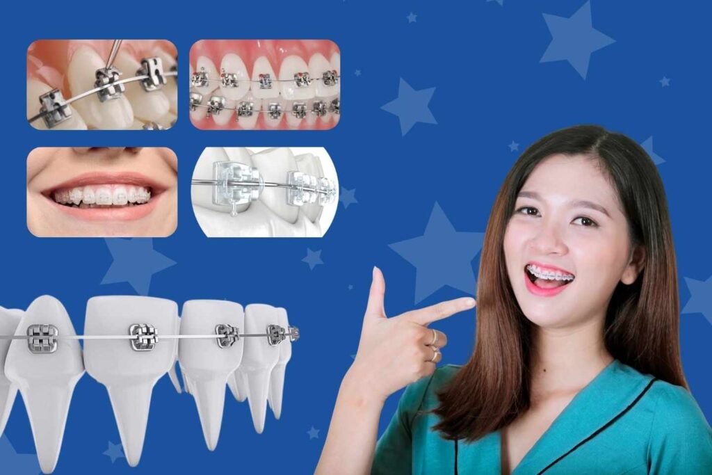 Giới thiệu về niềng răng mắc cài Nha Khoa Alpha