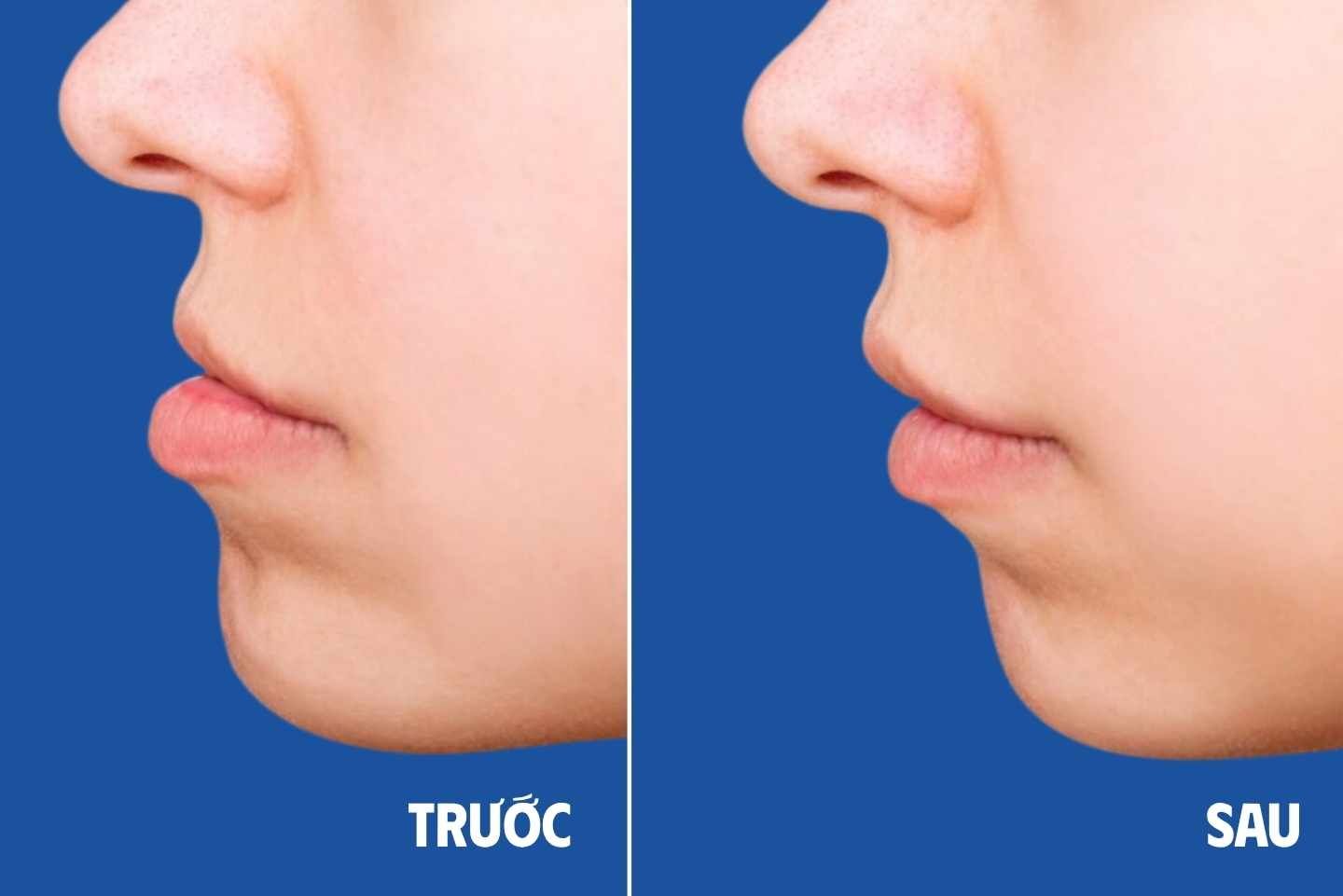 Trước và sau khi niềng răng mắc cài