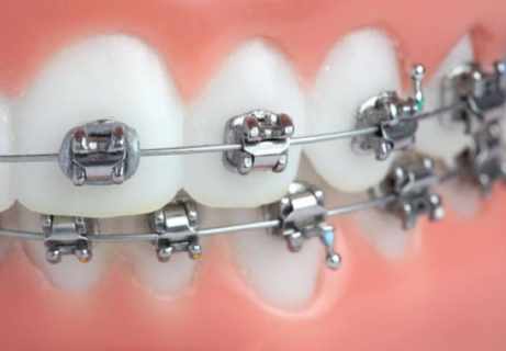 Mắc Cài Tự buộc