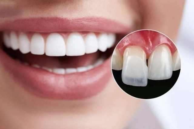Dán sứ veneer Alpha