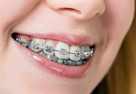 Mắc cài mặt ngoài kiểu truyền thống