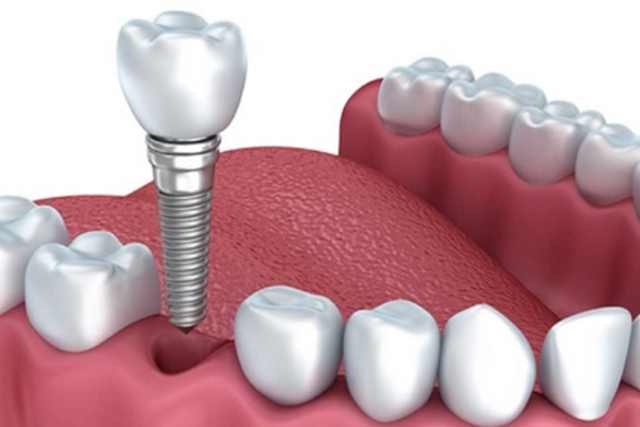 Cắm Implant Nha Khoa Alpha
