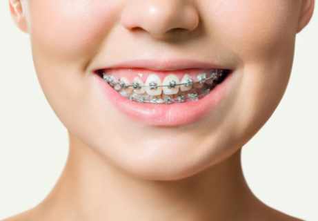 Niềng răng mắc cài truyền thống