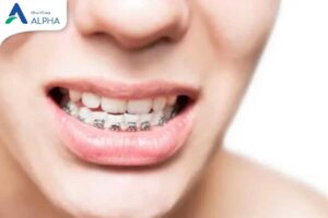 3 Điều có thể bạn chưa biết trong thời gian niềng răng