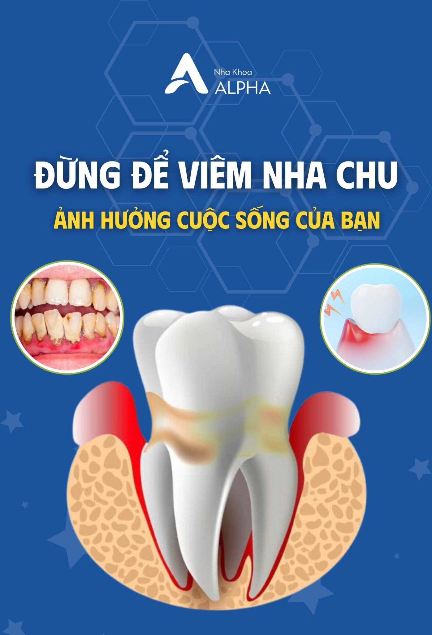 Viêm Nha Chu - Đến ngay Nha Khoa Alpha