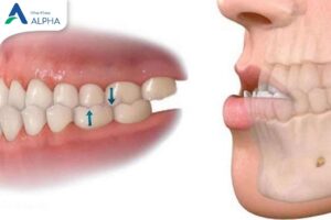 Sai khớp cắn - thói quen lâu ngày gây ra răng lung lay