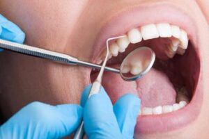 Cao răng là gì? Vì sao cần lấy cao răng định kỳ?