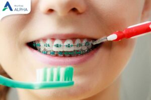 3 Điều có thể bạn chưa biết trong thời gian niềng răng