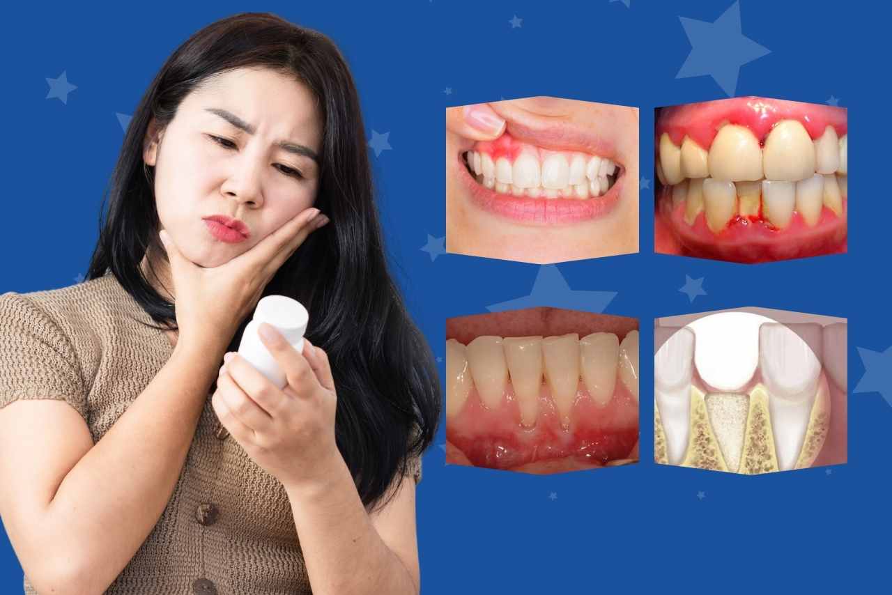 Các vấn đề nha chu thường gặp