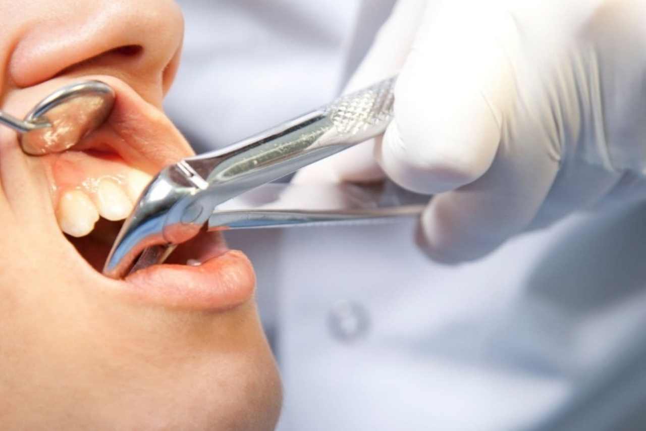 Giới thiệu về phương pháp nhổ răng