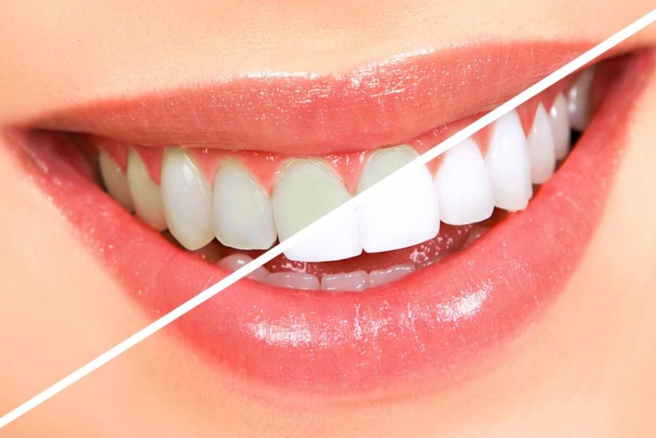 Giới thiệu về phương pháp Tẩy trắng răng