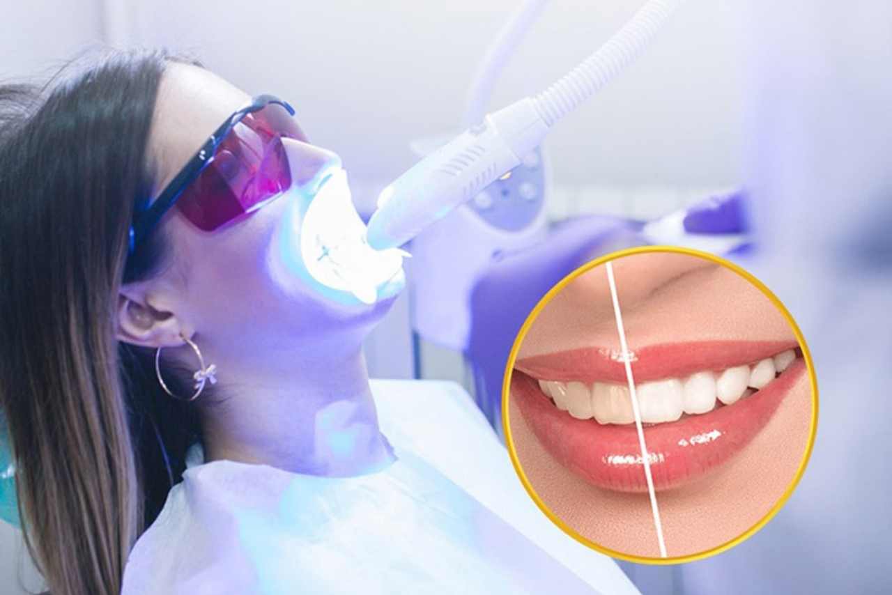 Lợi ích khi Tẩy Trắng Răng