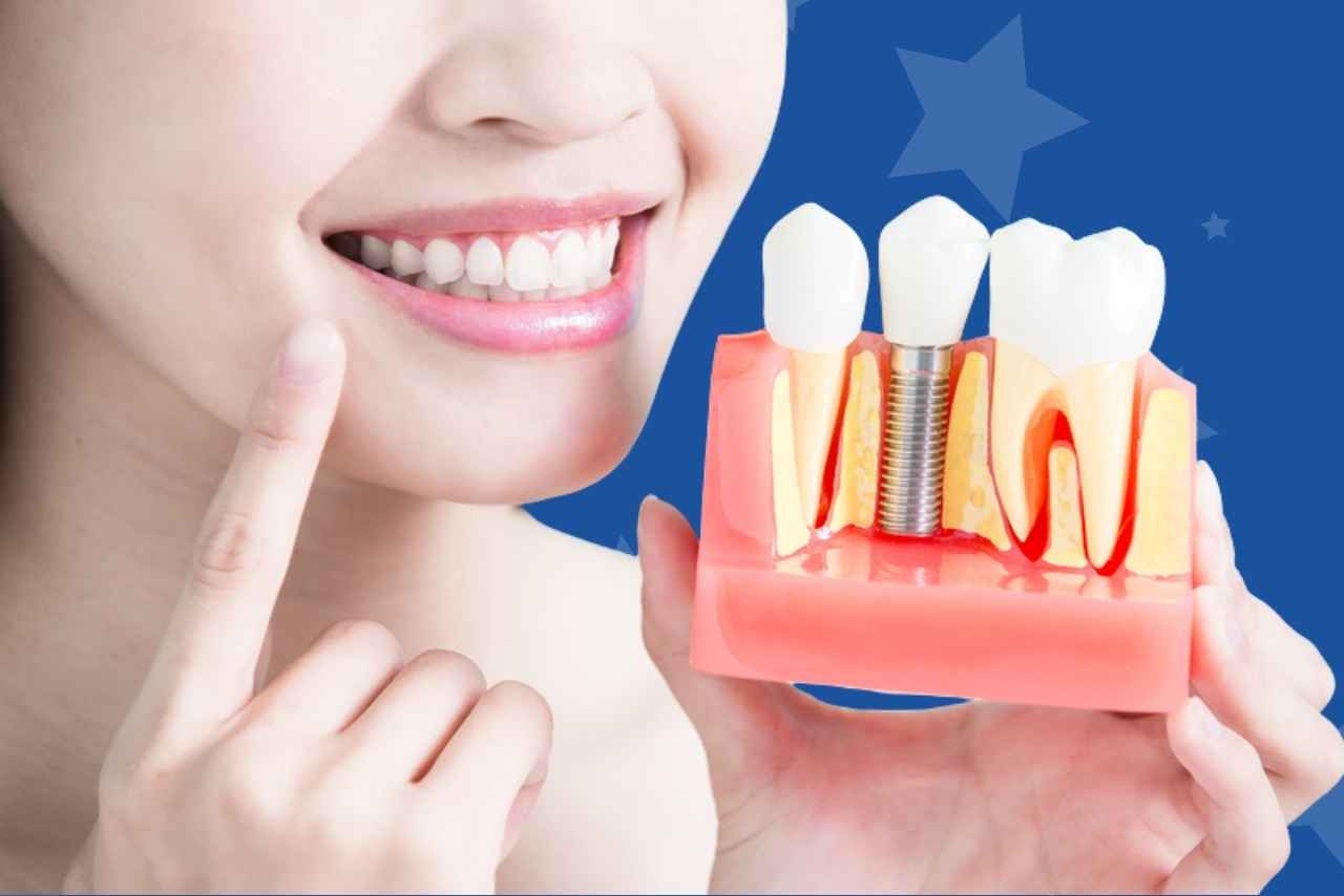Giới thiệu về cấy ghép Implant tại Alpha