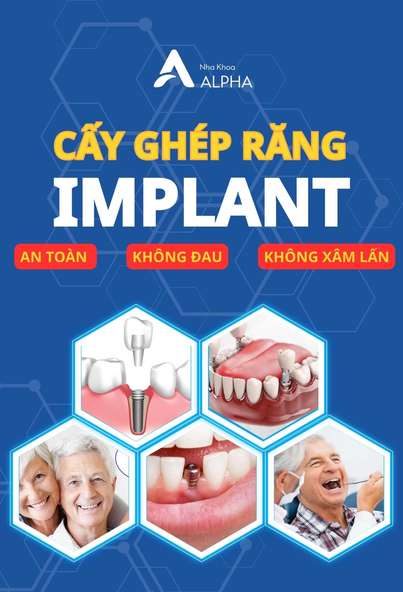 Cấy Ghép Răng Implant tại Nha Khoa Alpha