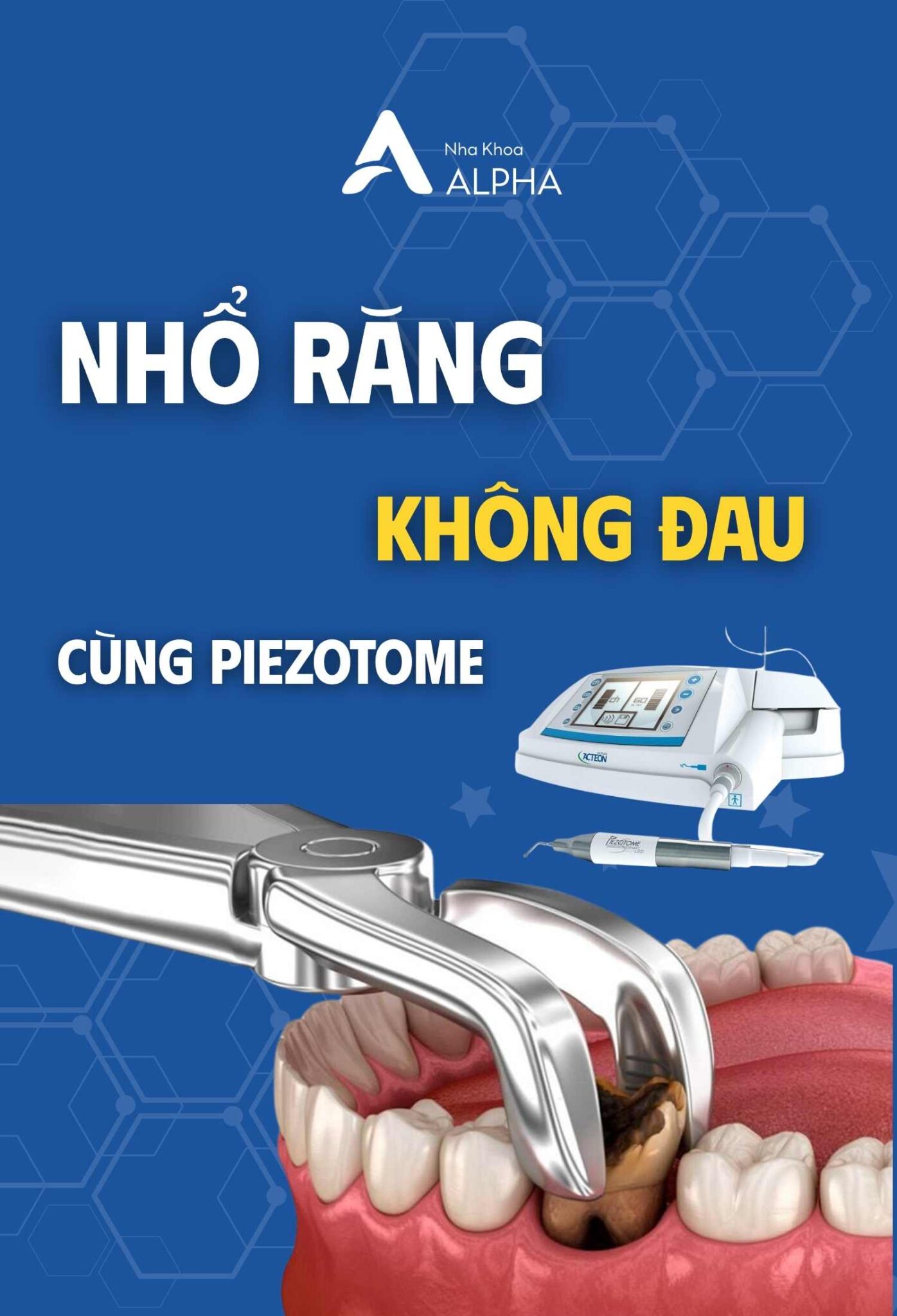 Nhổ răng không đau tại Nha Khoa Alpha