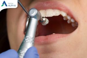 Lưu ý đặc biệt khi niềng răng ở tuổi trung niên