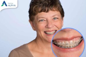 Người 40–60 tuổi có niềng răng được không?