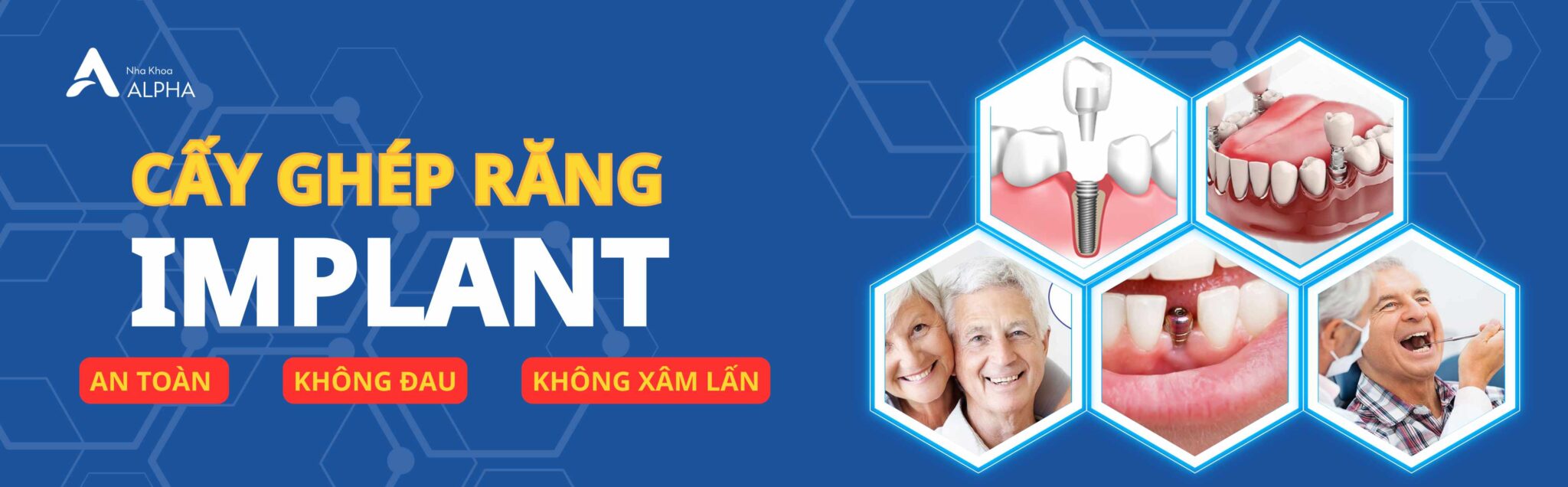 Cấy ghép Implant tại Nha Khoa Alpha