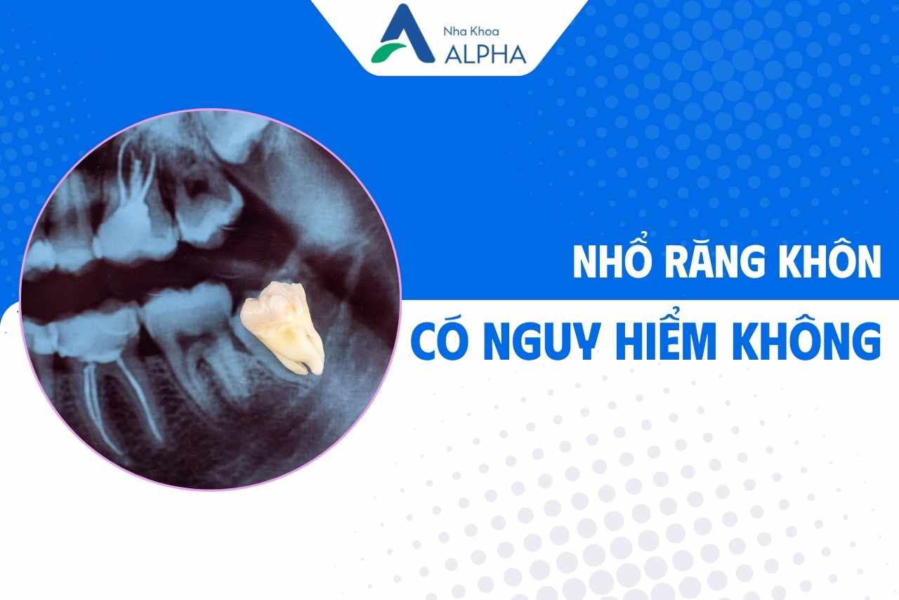 Nhổ răng khôn có nguy hiểm không? Những yếu tố ảnh hưởng