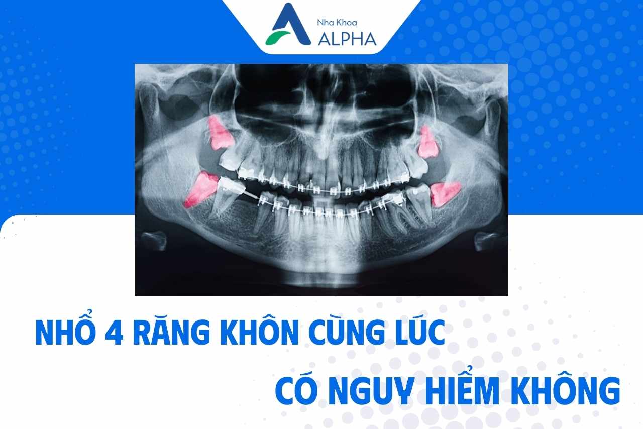 Nhổ 4 răng khôn cùng 1 lúc có nguy hiểm không? Lưu ý trước nhổ