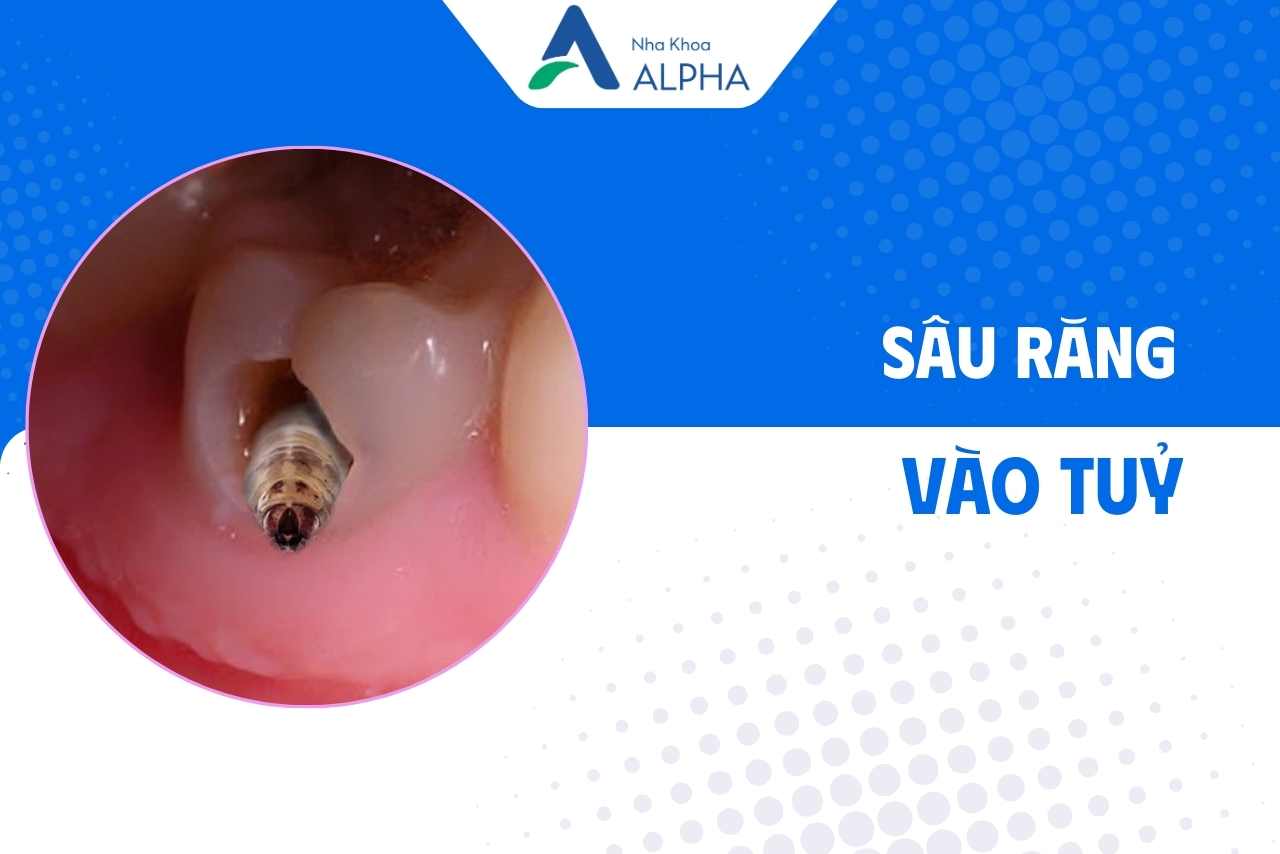 nguyên nhân chính dẫn đến viêm tuỷ - Sâu răng vào tuỷ