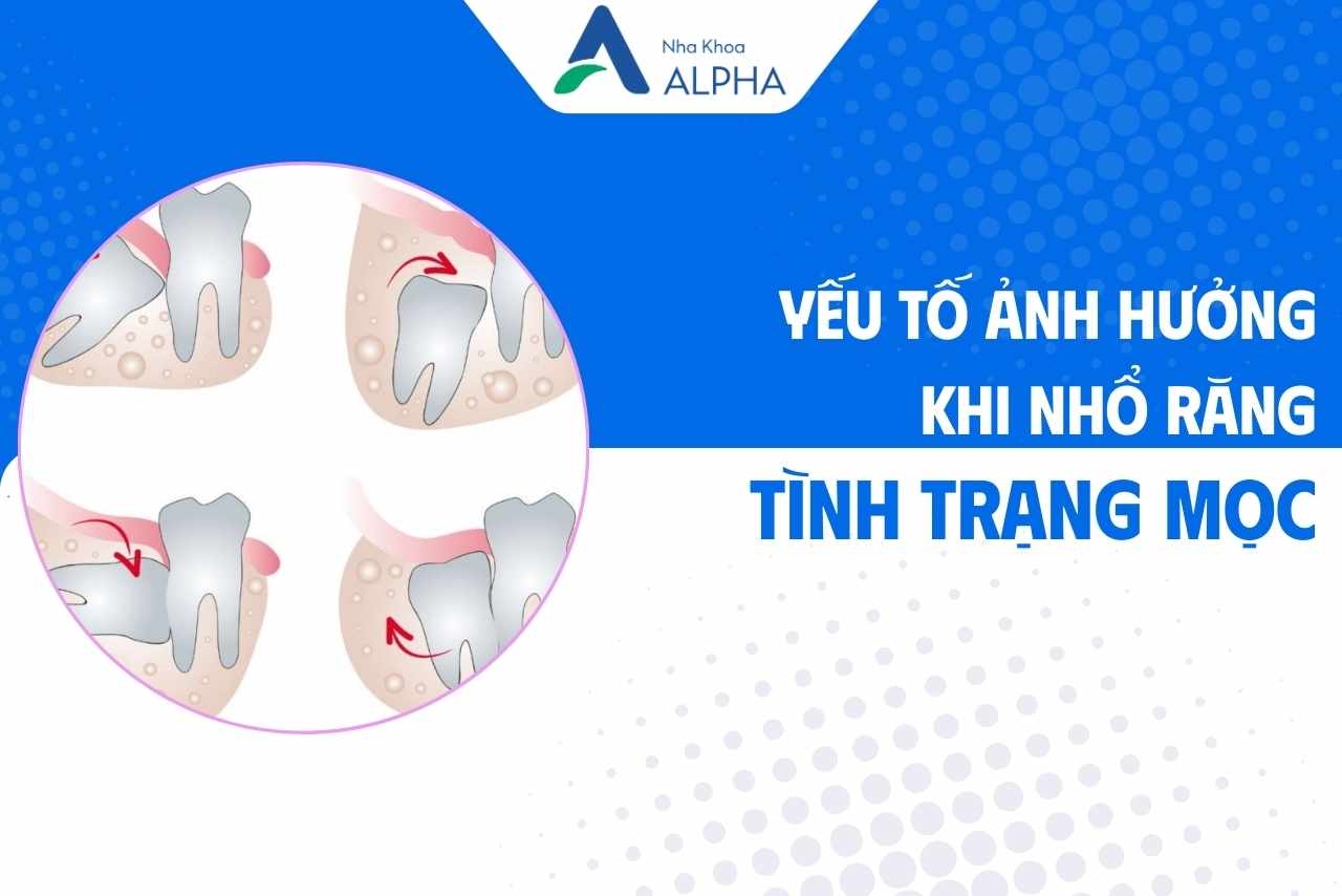 Những yếu tố ảnh hưởng đến an toàn khi nhổ 4 răng khôn - Tình trạng răng