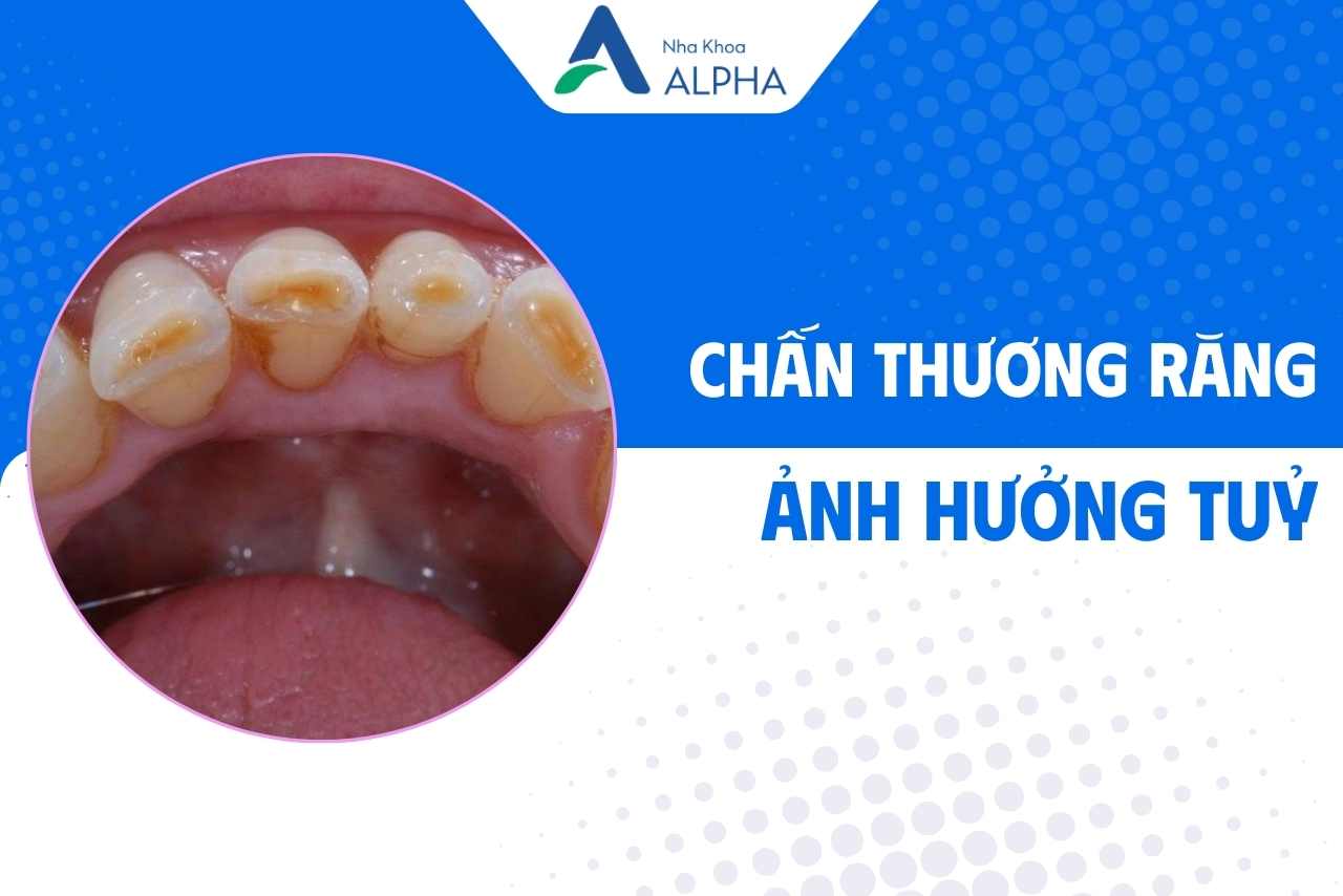 nguyên nhân chính dẫn đến viêm tuỷ - chấn thương răng 