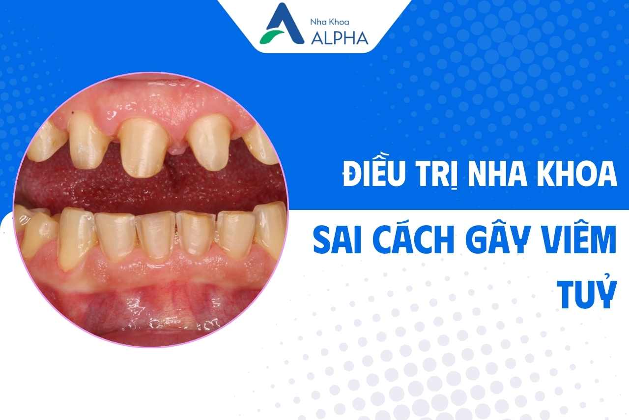 nguyên nhân chính dẫn đến viêm tuỷ - điều trị nha khoa sai cách
