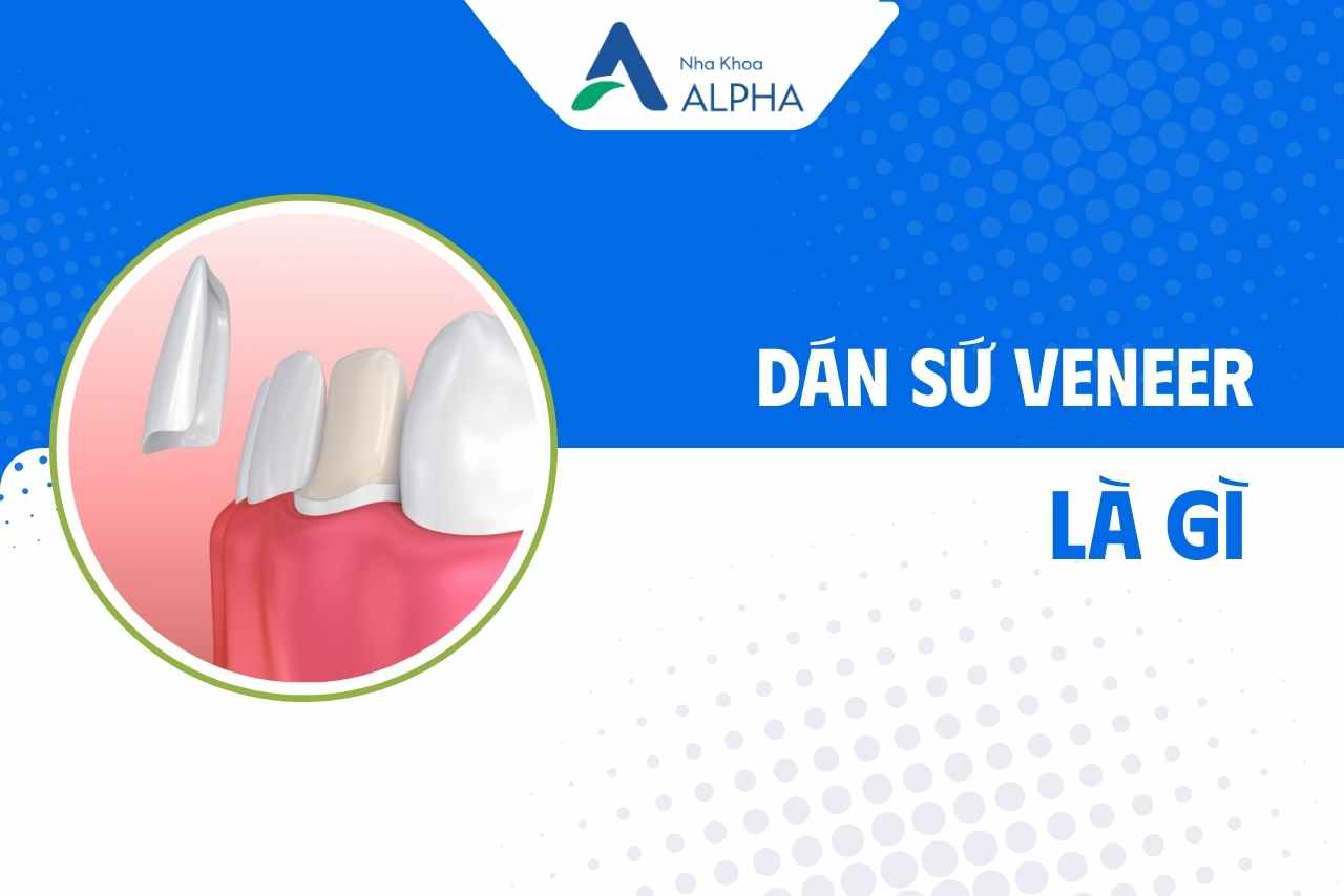 Dán răng sứ Veneer là gì?