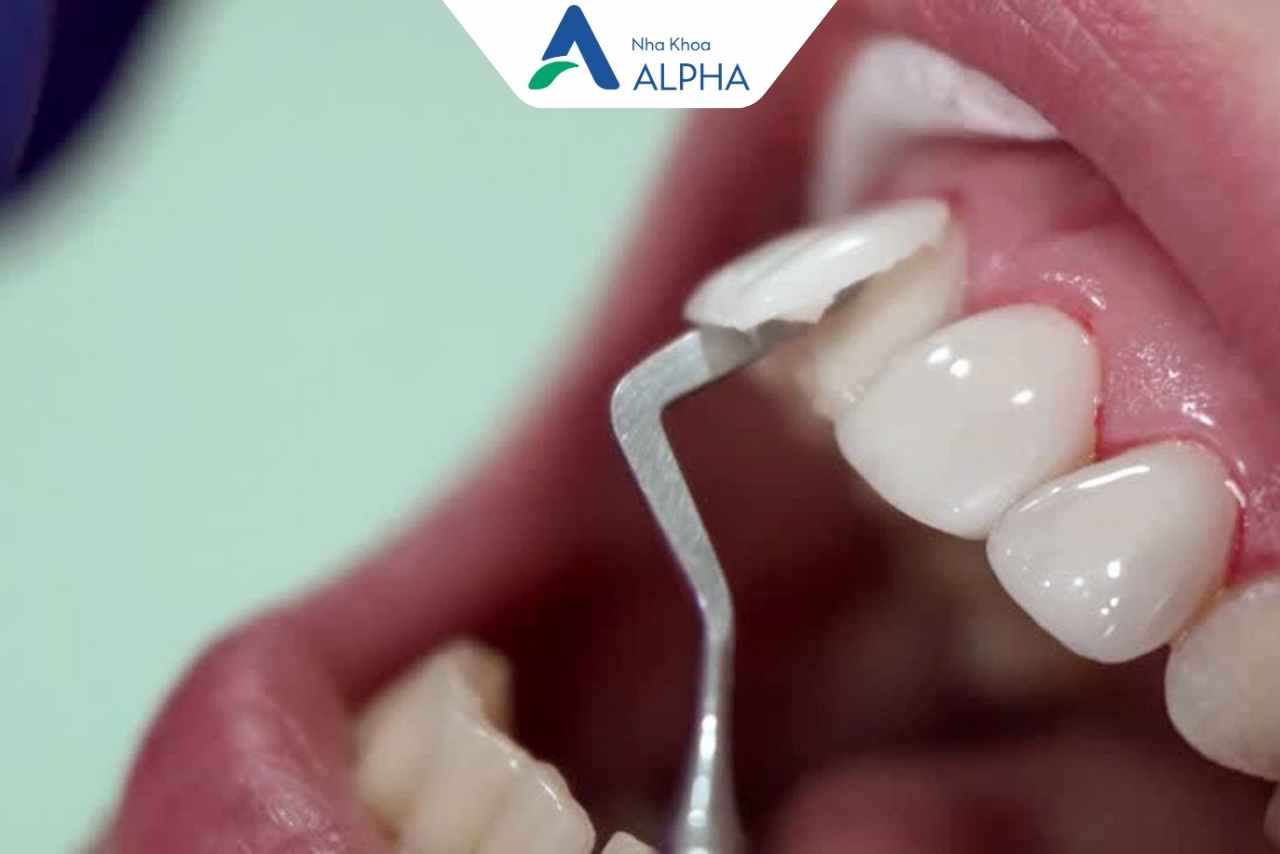 Ưu điểm của phương pháp dán sứ Veneer