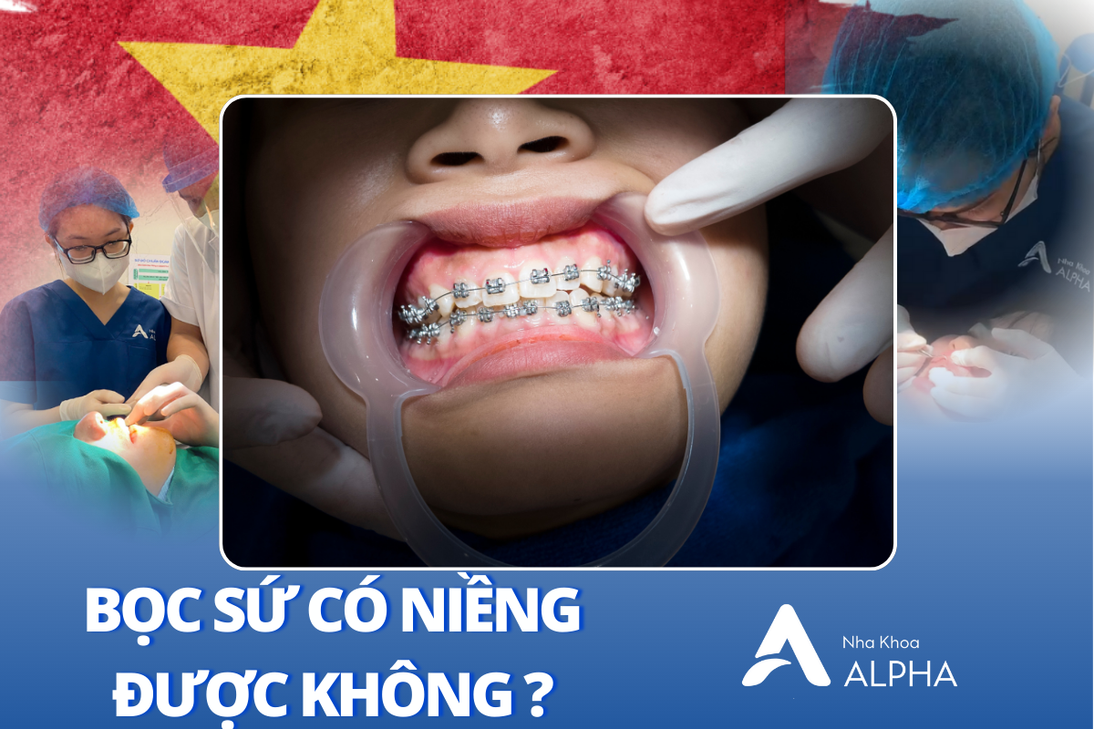 Niềng răng là phương pháp điều chỉnh vị trí răng bằng cách sử dụng các khí cụ nha khoa như mắc cài và dây cung.